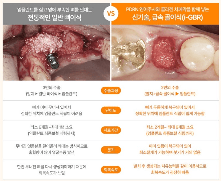 전통적인 뼈이식 vs 신기술 급속 골이식(i-GBR) 비교
